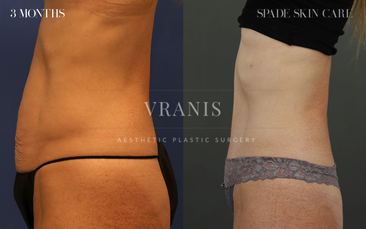 Sugical-Gallery-Midsection-Contouring-5