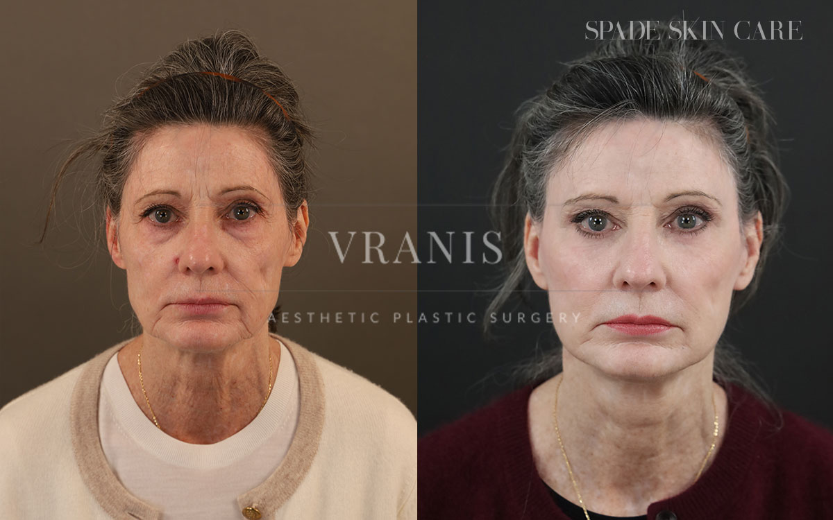 Face-Rejuvenation-Result-10