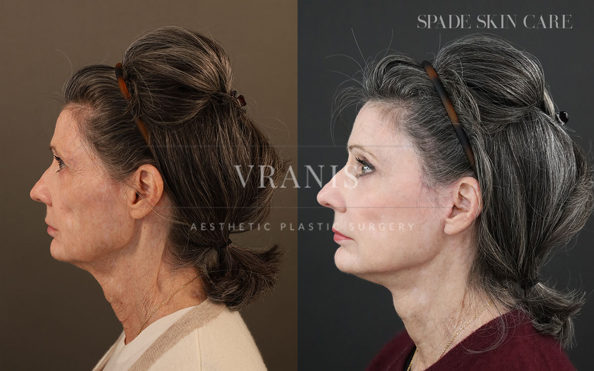 Face-Rejuvenation-Result-11