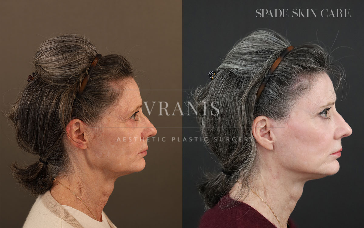 Face-Rejuvenation-Result-13
