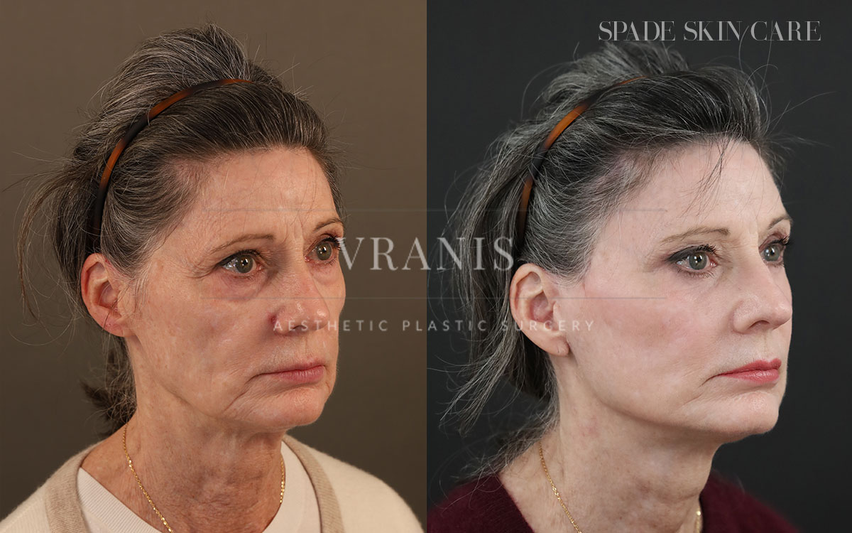 Face-Rejuvenation-Result-14